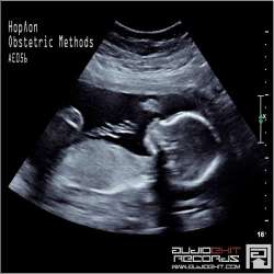 [AE056] Hoplon - Obstetric Methods